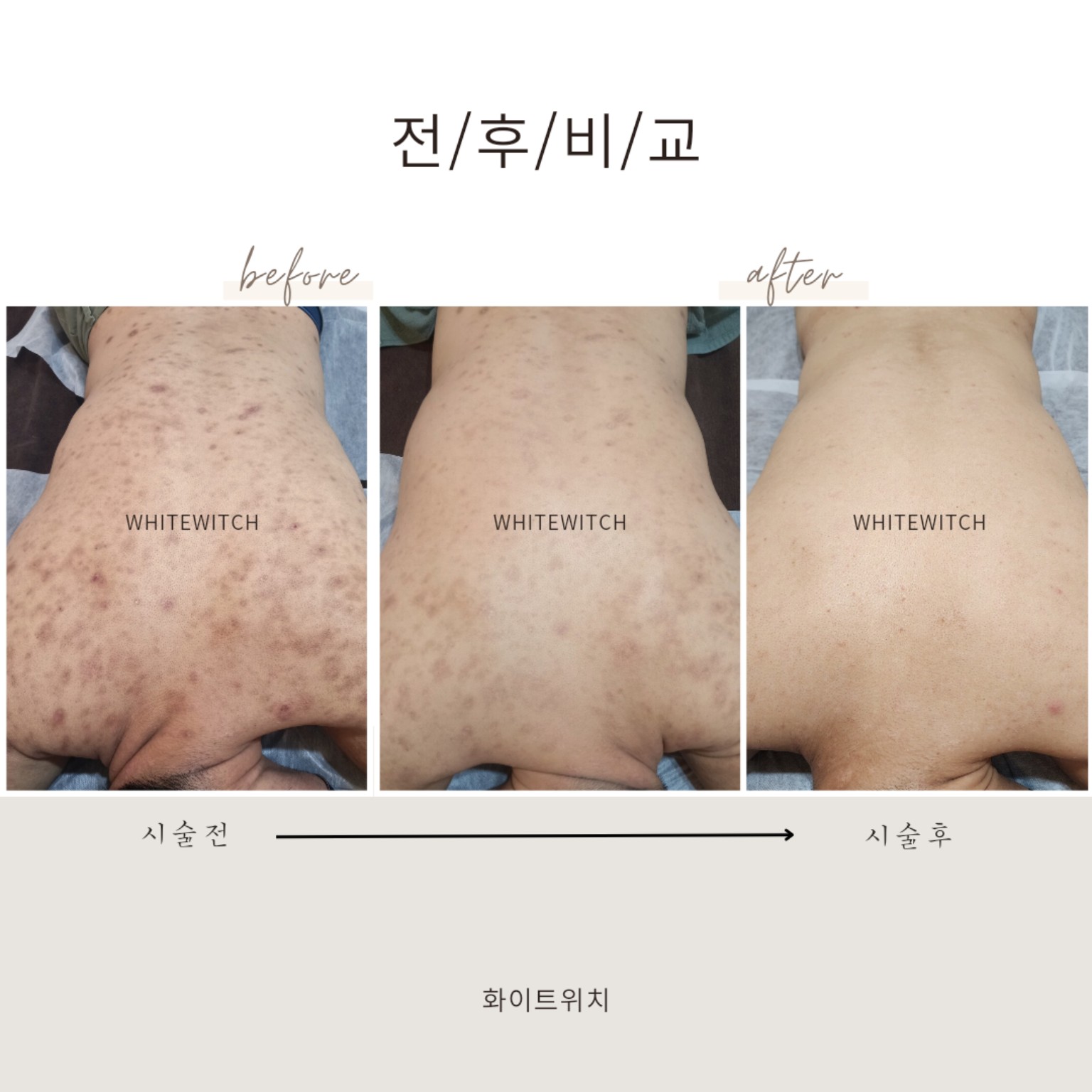 바디 피부관리 전후 실제 사례 2