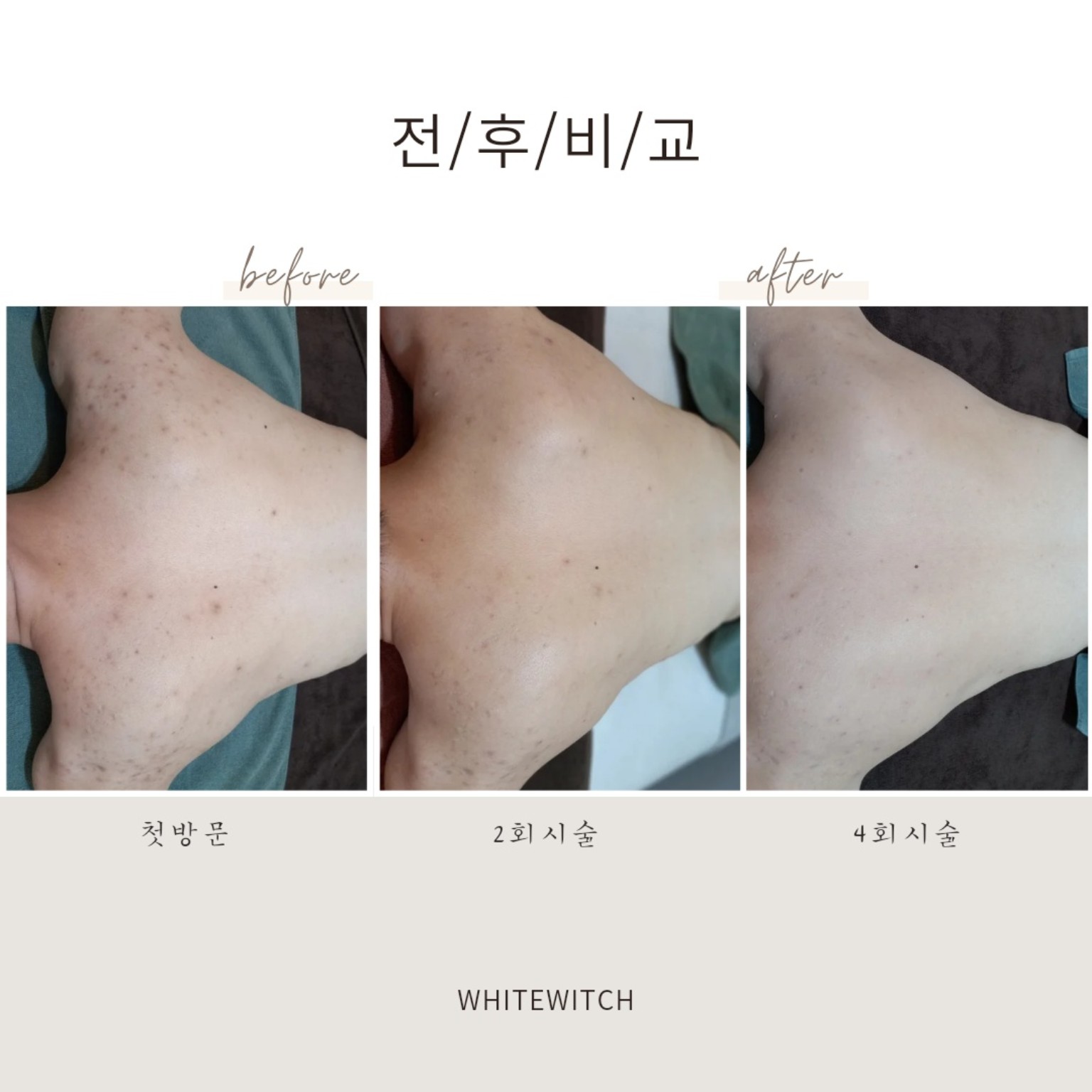 바디 피부관리 전후 실제 사례 4