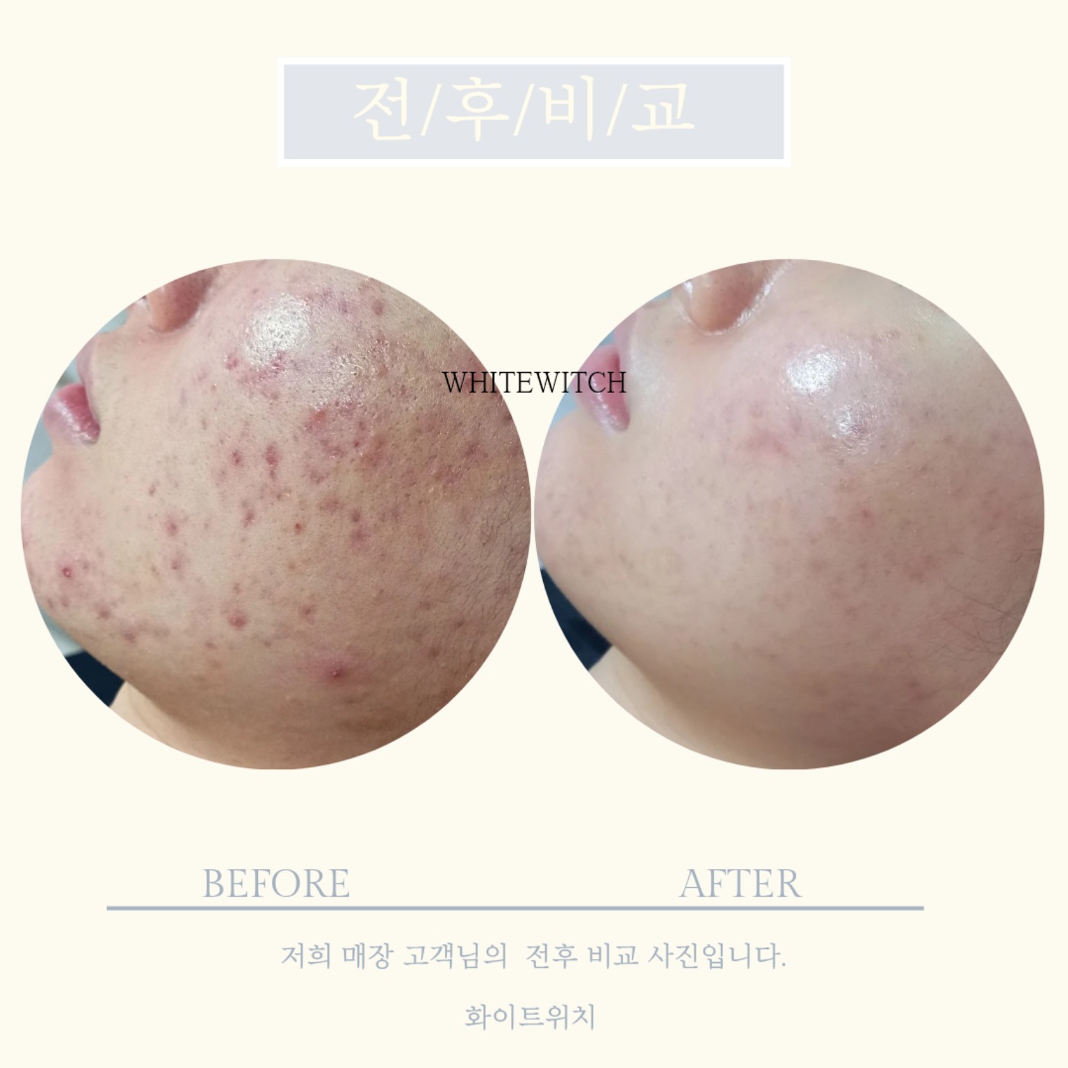 인천 얼굴 트러블 피부관리 실제 사례 1