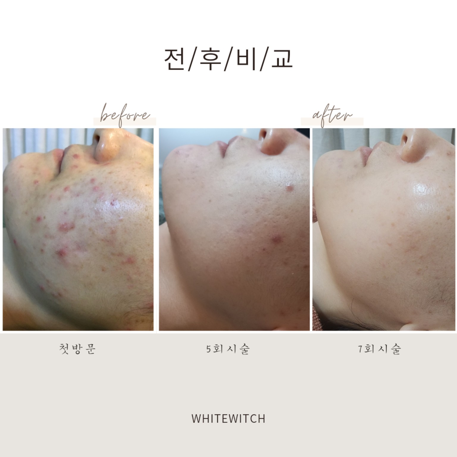 구월동 얼굴 문제성 피부관리 실제 사례 2
