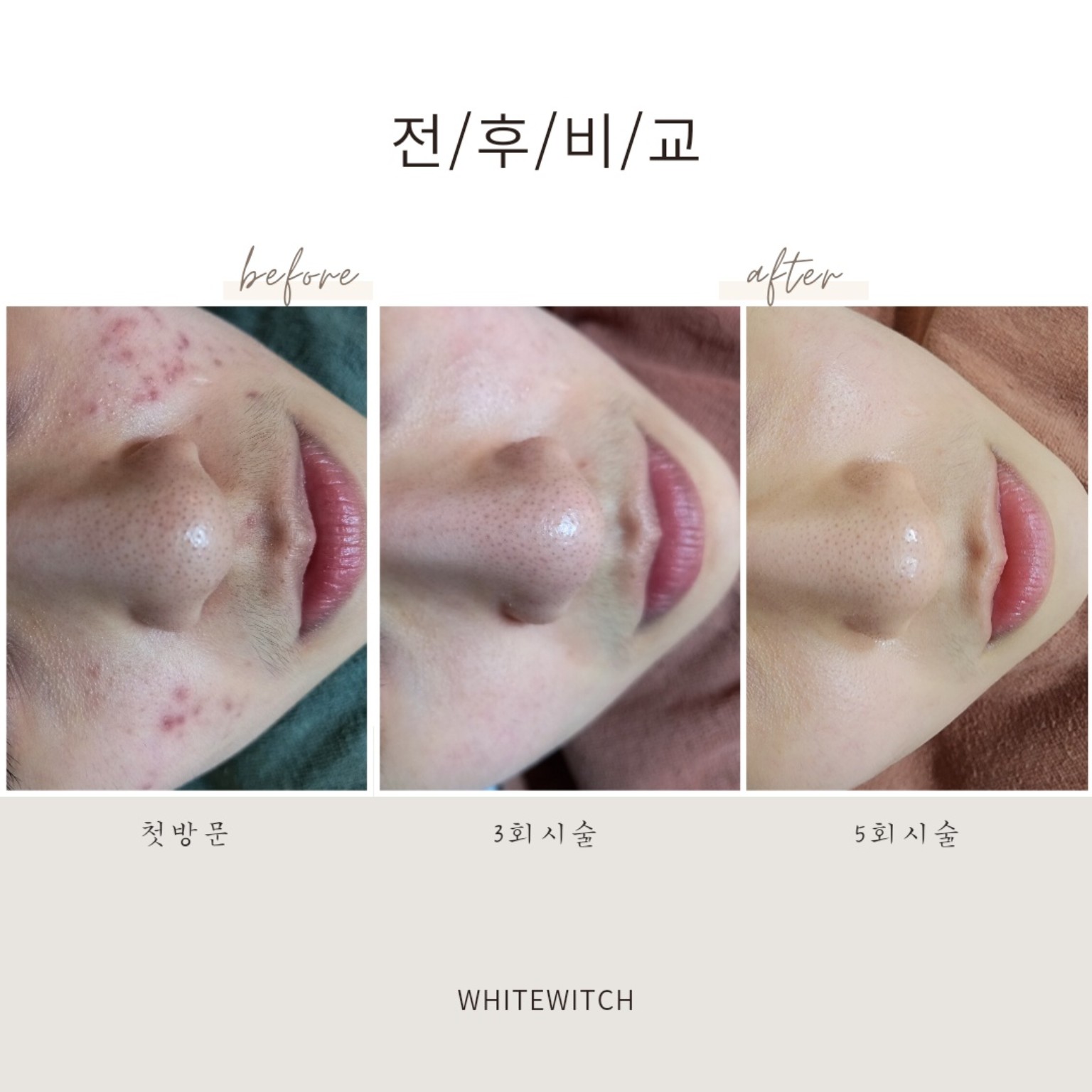 인천 구월동 얼굴 트러블 피부관리 실제 사례 3