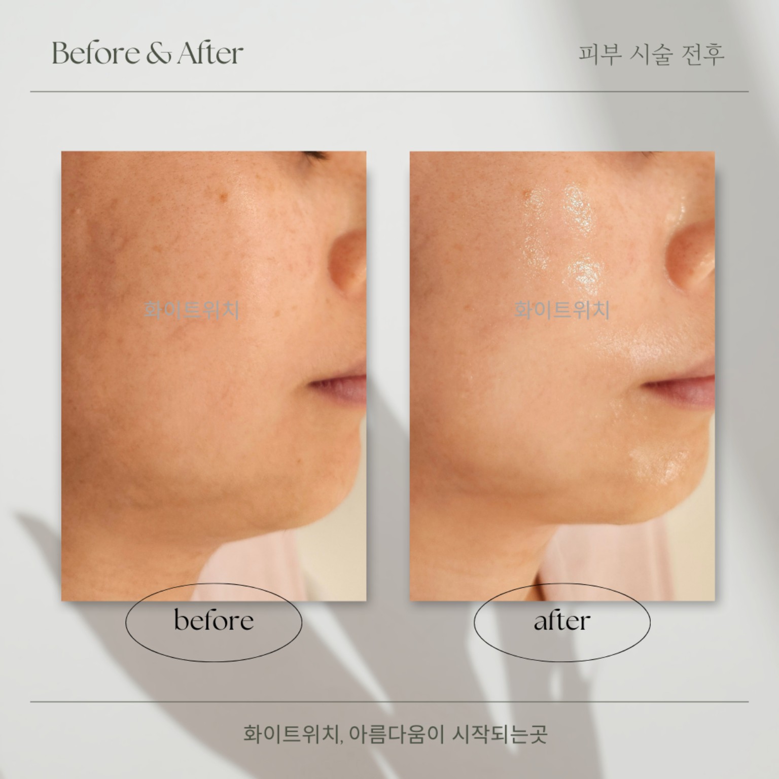 인천 웨딩케어 얼굴 피부관리 실제 사례 1