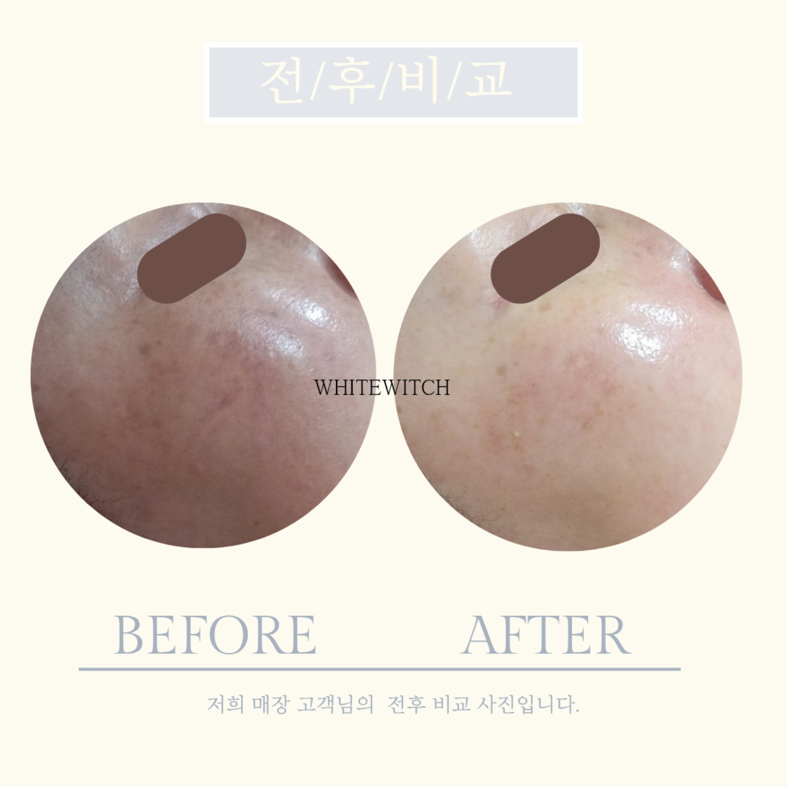 구월동 웨딩 피부관리 실제 사례 2